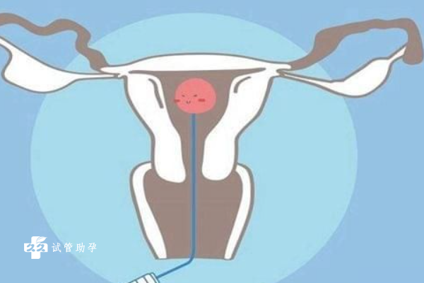 患有子宫内膜炎如何做试管，治好后再做试管更容易受孕